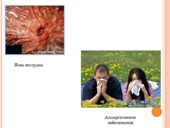Язва желудка Аллергические заболевания 