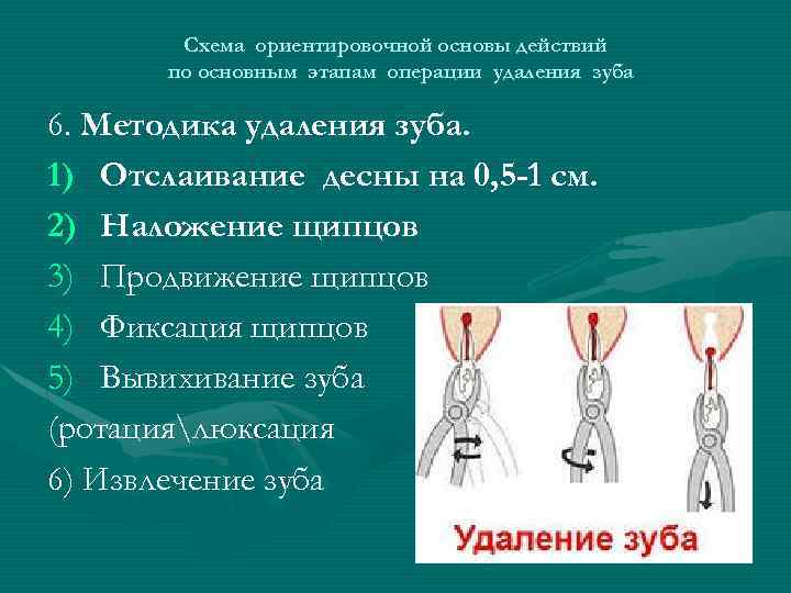 Схема ориентировочной основы действий по основным этапам операции удаления зуба 6. Методика удаления зуба.