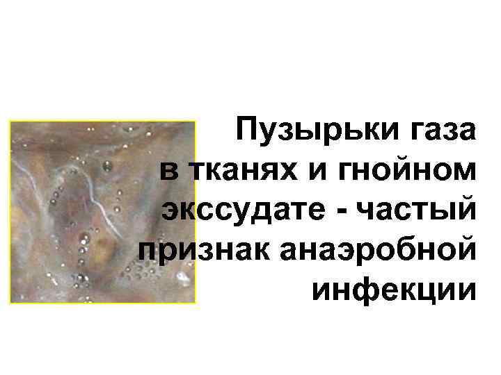 Пузырьки газа в тканях и гнойном экссудате - частый признак анаэробной инфекции 
