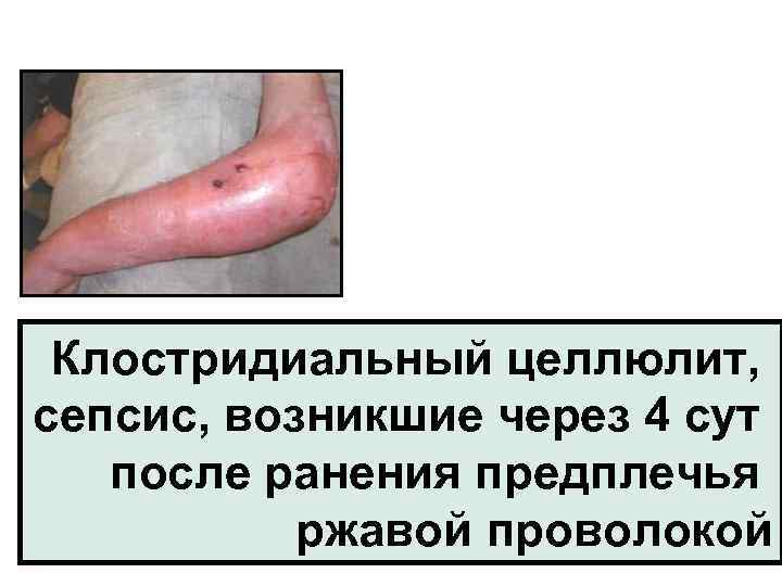 Клостридиальный целлюлит, сепсис, возникшие через 4 сут после ранения предплечья ржавой проволокой 