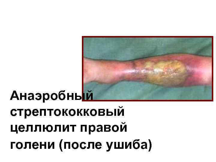 Анаэробный стрептококковый целлюлит правой голени (после ушиба) 