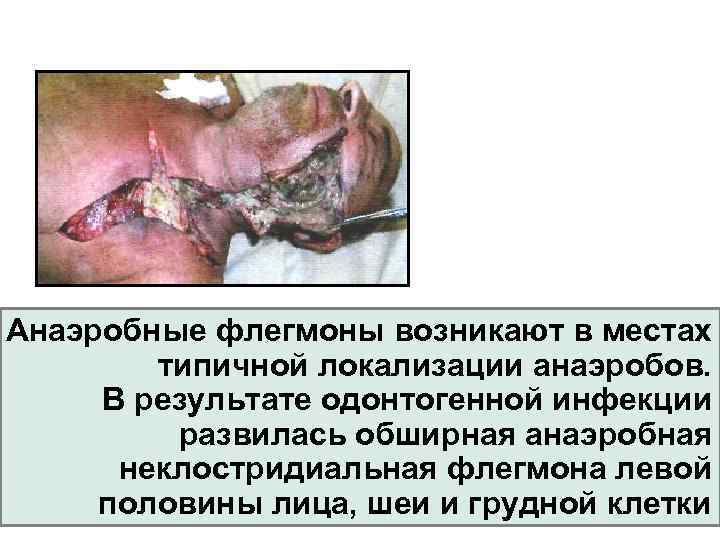 Анаэробные флегмоны возникают в местах типичной локализации анаэробов. В результате одонтогенной инфекции развилась обширная