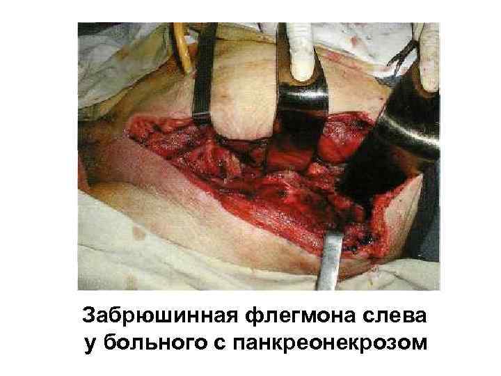 Забрюшинная флегмона слева у больного с панкреонекрозом 