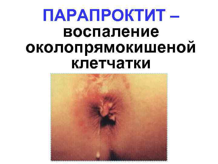ПАРАПРОКТИТ – воспаление околопрямокишеной клетчатки 