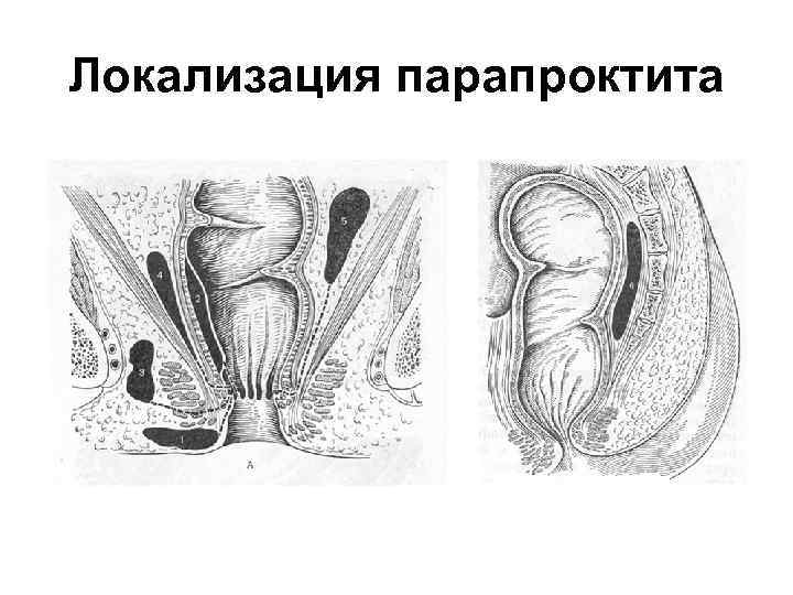 Локализация парапроктита 