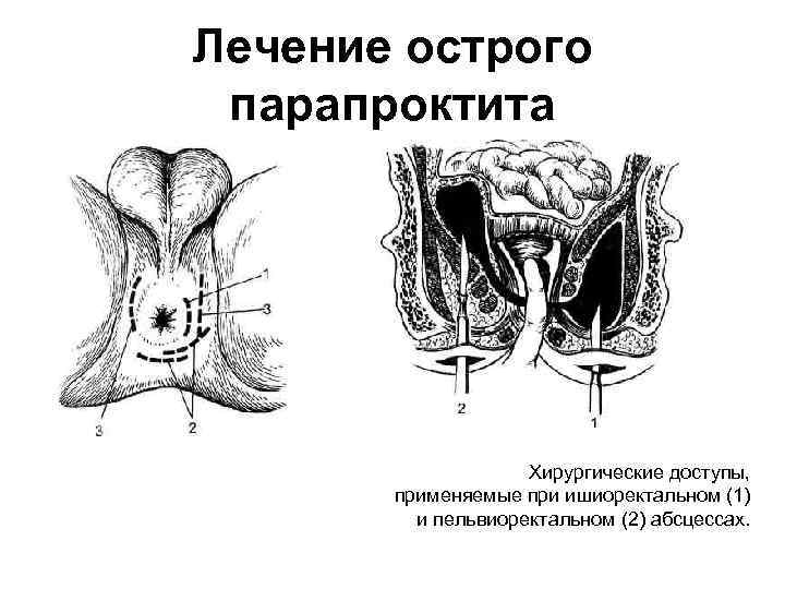 Лечение острого парапроктита Хирургические доступы, применяемые при ишиоректальном (1) и пельвиоректальном (2) абсцессах. 