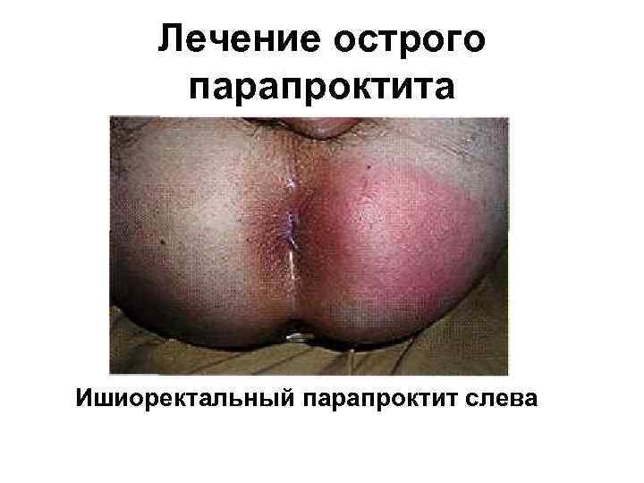 Лечение острого парапроктита Ишиоректальный парапроктит слева 
