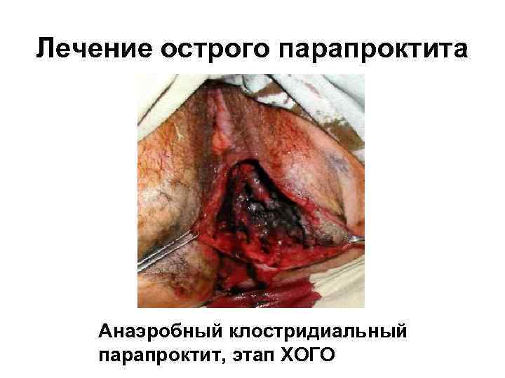 Лечение острого парапроктита Анаэробный клостридиальный парапроктит, этап ХОГО 