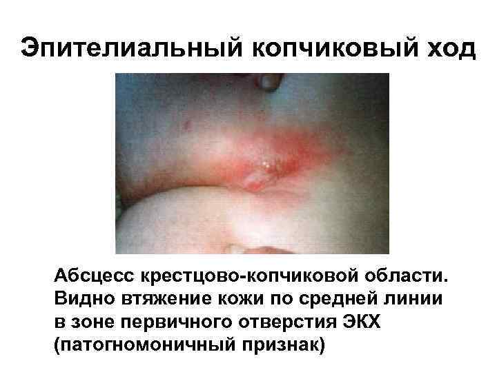 Эпителиальный копчиковый ход Абсцесс крестцово-копчиковой области. Видно втяжение кожи по средней линии в зоне