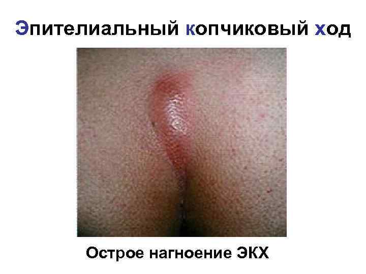 Эпителиальный копчиковый ход Острое нагноение ЭКХ 