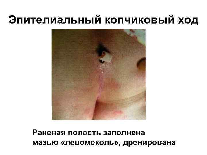 Эпителиальный копчиковый ход Раневая полость заполнена мазью «левомеколь» , дренирована 
