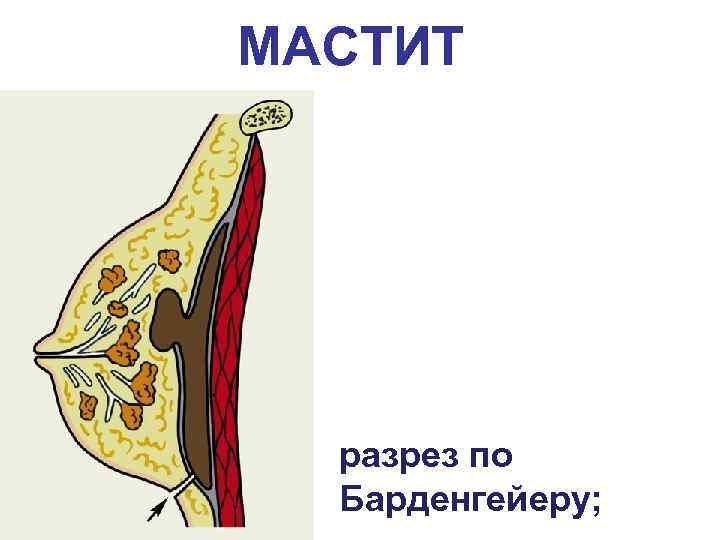 МАСТИТ разрез по Барденгейеру; 