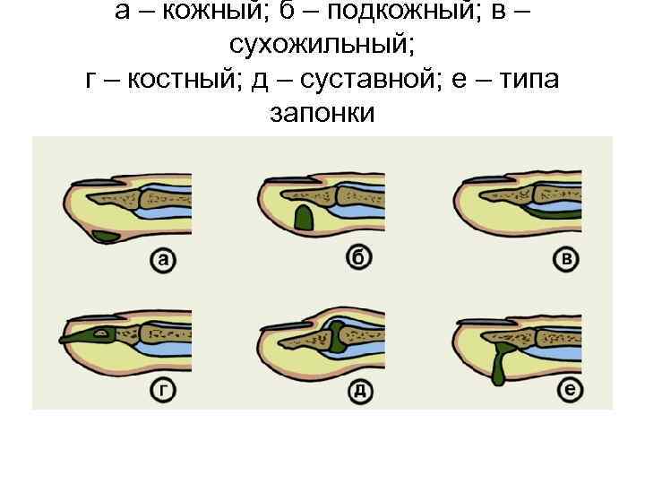 а – кожный; б – подкожный; в – сухожильный; г – костный; д –