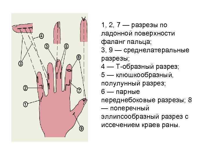 1, 2, 7 — разрезы по ладонной поверхности фаланг пальца; 3, 9 — среднелатеральные