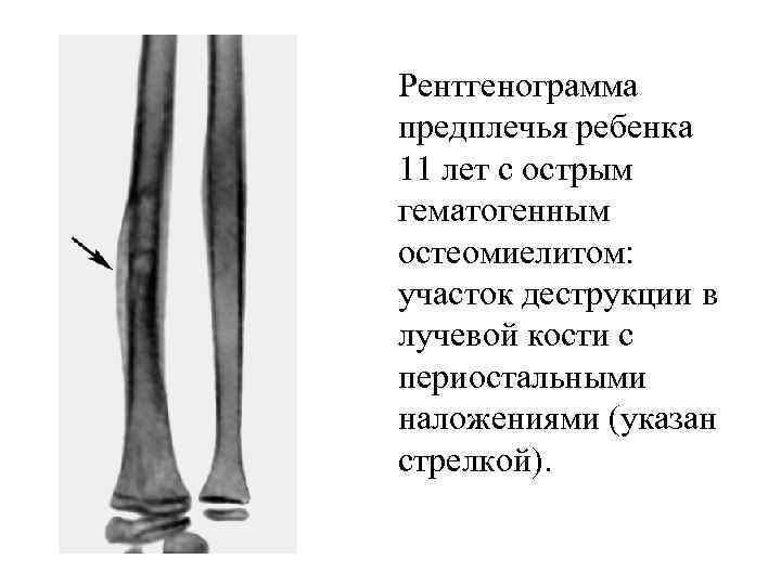 Рентгенограмма предплечья ребенка 11 лет с острым гематогенным остеомиелитом: участок деструкции в лучевой кости