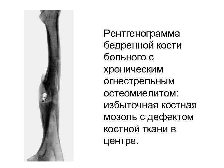 Рентгенограмма бедренной кости больного с хроническим огнестрельным остеомиелитом: избыточная костная мозоль с дефектом костной