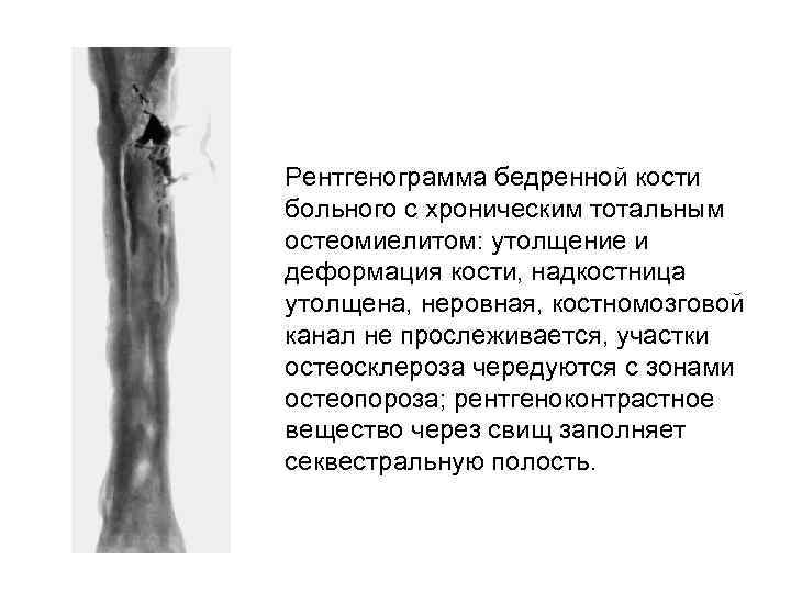 Рентгенограмма бедренной кости больного с хроническим тотальным остеомиелитом: утолщение и деформация кости, надкостница утолщена,