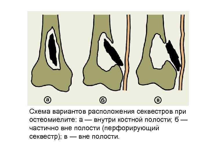 Схема вариантов расположения секвестров при остеомиелите: а — внутри костной полости; б — частично