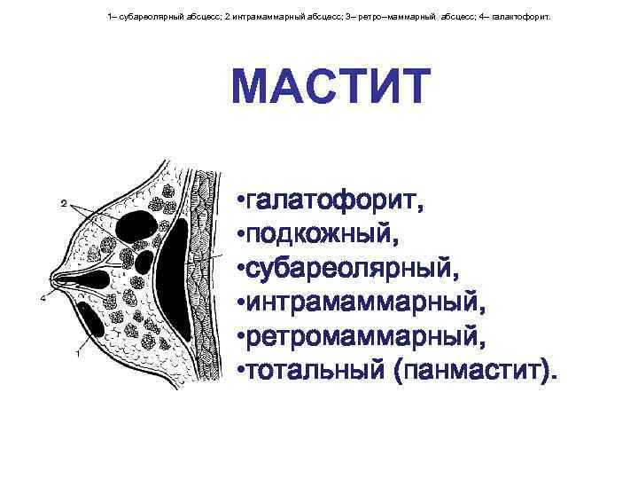 1– субареолярный абсцесс; 2 интрамаммарный абсцесс; 3– ретро–маммарный абсцесс; 4– галактофорит. МАСТИТ • галатофорит,