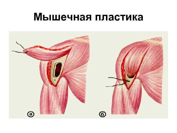 Мышечная пластика 