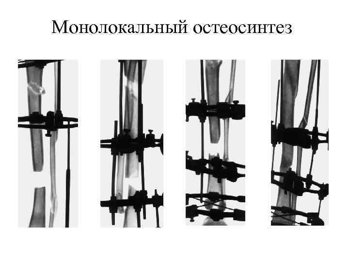 Монолокальный остеосинтез 