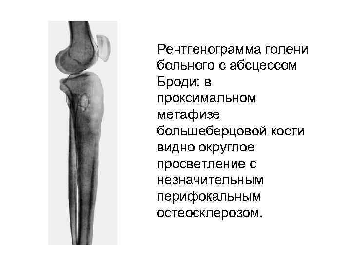 Рентгенограмма голени больного с абсцессом Броди: в проксимальном метафизе большеберцовой кости видно округлое просветление