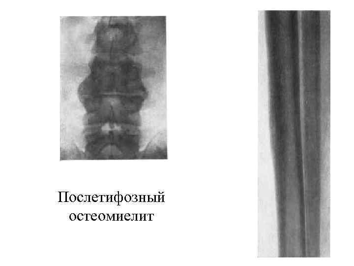 Послетифозный остеомиелит 