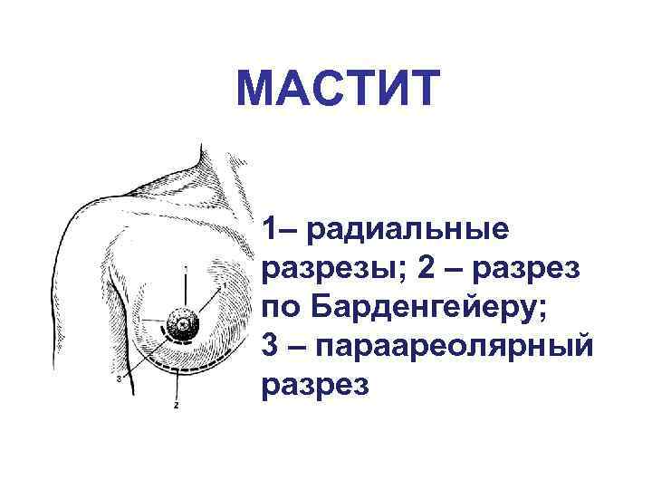 МАСТИТ 1– радиальные разрезы; 2 – разрез по Барденгейеру; 3 – параареолярный разрез 