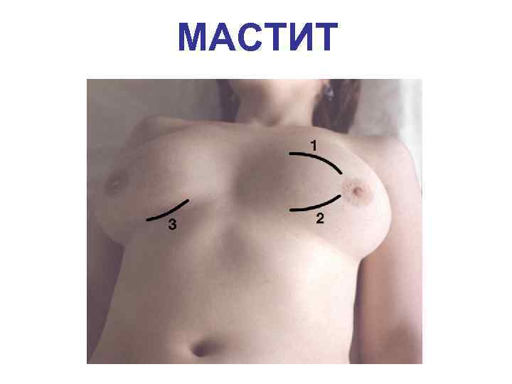 МАСТИТ 