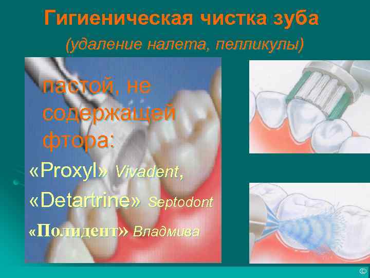 Гигиеническая чистка зуба (удаление налета, пелликулы) пастой, не содержащей фтора: «Proxyl» Vivadent, «Detartrine» Septodont