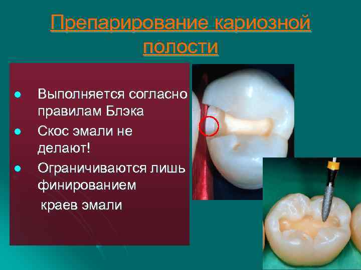 Препарирование кариозной полости l l l Выполняется согласно правилам Блэка Скос эмали не делают!