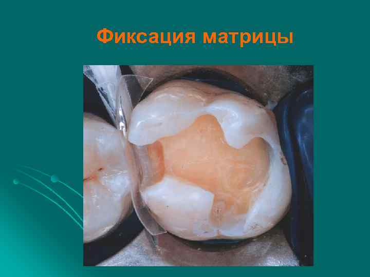 Фиксация матрицы 