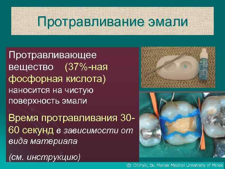 Протравливание эмали Протравливающее вещество (37%-ная фосфорная кислота) наносится на чистую поверхность эмали Время протравливания