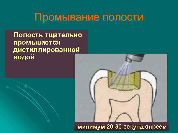 Промывание полости Полость тщательно промывается дистиллированной водой минимум 20 -30 секунд спреем 