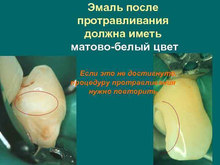 Эмаль после протравливания должна иметь матово-белый цвет Если это не достигнуто, процедуру протравливания нужно