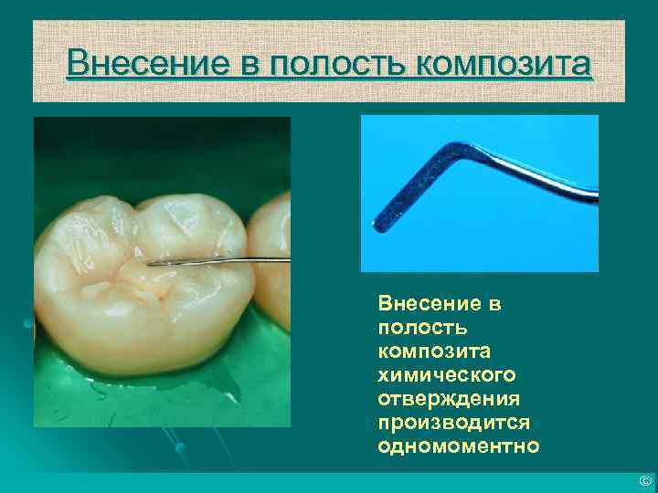 Внесение в полость композита химического отверждения производится одномоментно © 