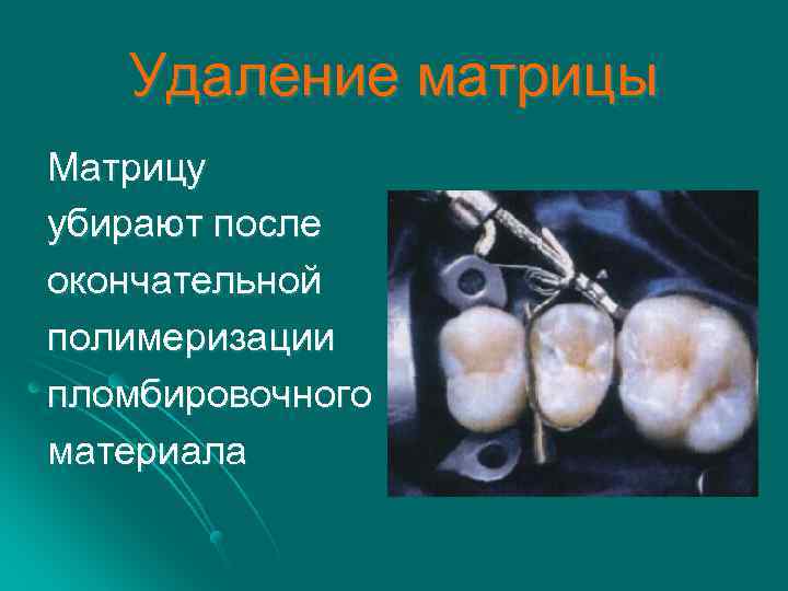 Удаление матрицы Матрицу убирают после окончательной полимеризации пломбировочного материала 