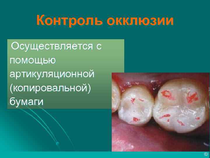 Контроль окклюзии Осуществляется с помощью артикуляционной (копировальной) бумаги © 