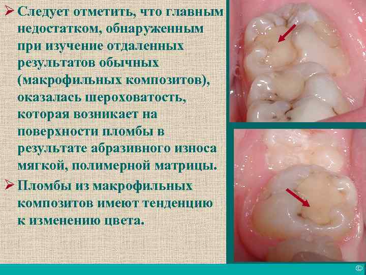 Ø Следует отметить, что главным недостатком, обнаруженным при изучение отдаленных результатов обычных (макрофильных композитов),