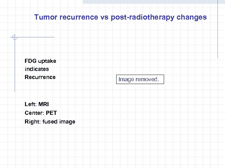 Tumor recurrence vs post-radiotherapy changes FDG uptake indicates Recurrence Left: MRI Center: PET Right: