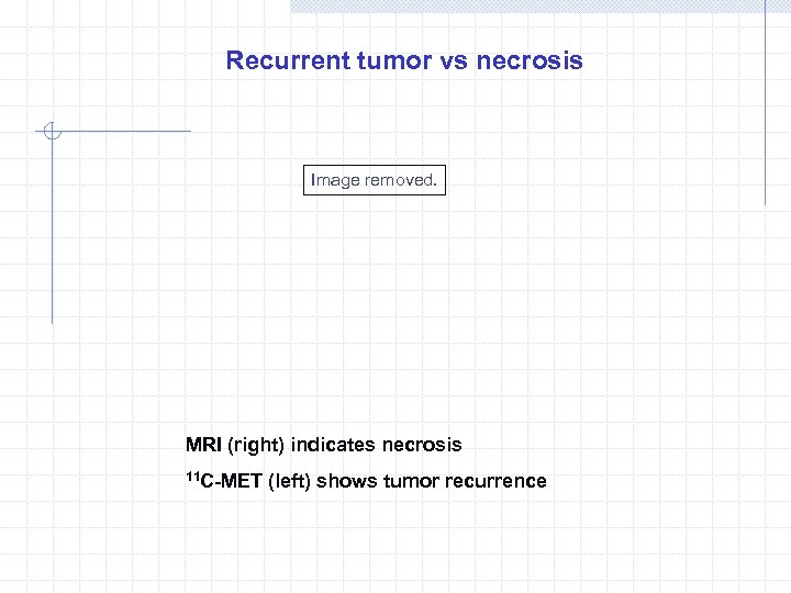 Recurrent tumor vs necrosis Image removed. MRI (right) indicates necrosis 11 C-MET (left) shows