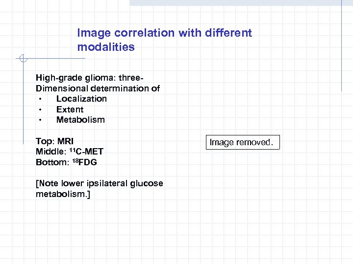 Image correlation with different modalities High-grade glioma: three. Dimensional determination of ‧ Localization ‧
