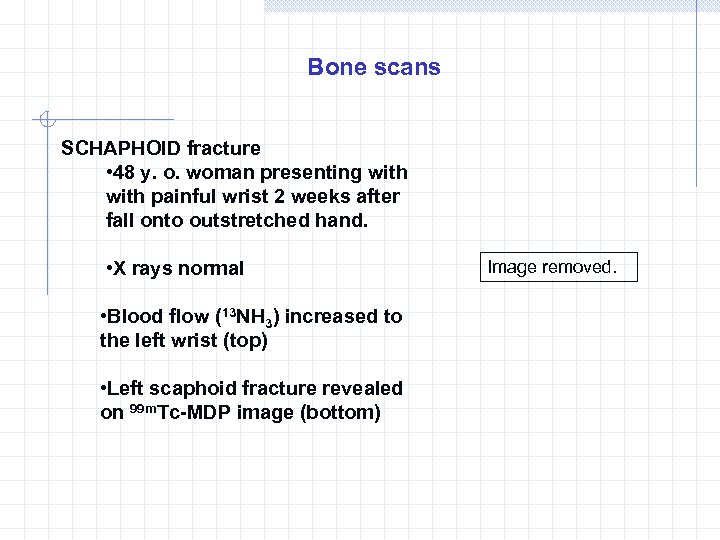 Bone scans SCHAPHOID fracture • 48 y. o. woman presenting with painful wrist 2