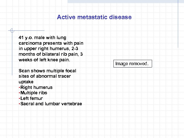 Active metastatic disease 41 y. o. male with lung carcinoma presents with pain in