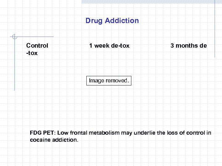 Drug Addiction Control -tox 1 week de-tox 3 months de Image removed. FDG PET: