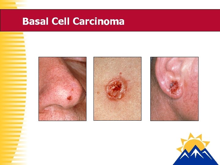 Basal Cell Carcinoma 