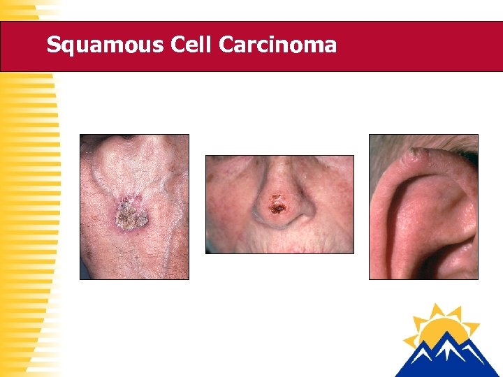 Squamous Cell Carcinoma 