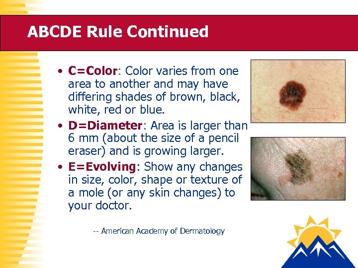 ABCDE Rule Continued • C=Color: Color varies from one area to another and may