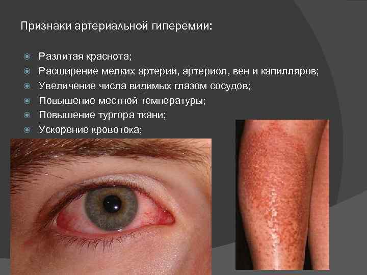 Признаки артериальной гиперемии: Разлитая краснота; Расширение мелких артерий, артериол, вен и капилляров; Увеличение числа