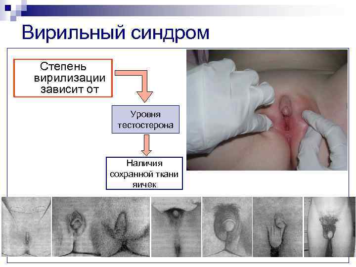 Вирильный синдром Степень вирилизации зависит от Уровня тестостерона Наличия сохранной ткани яичек 